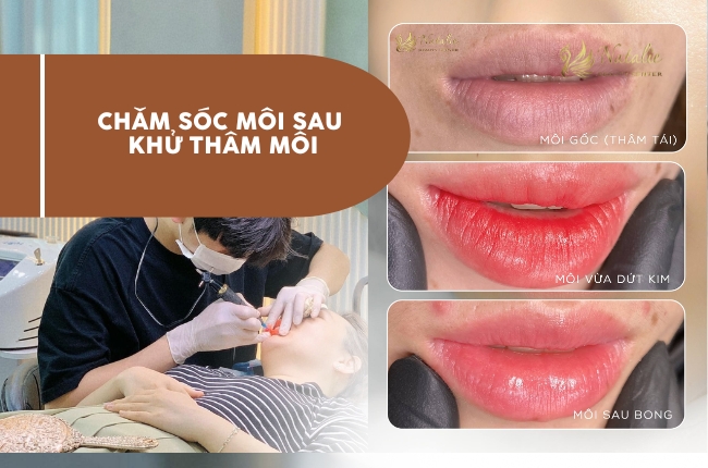 chăm sóc môi sau khử