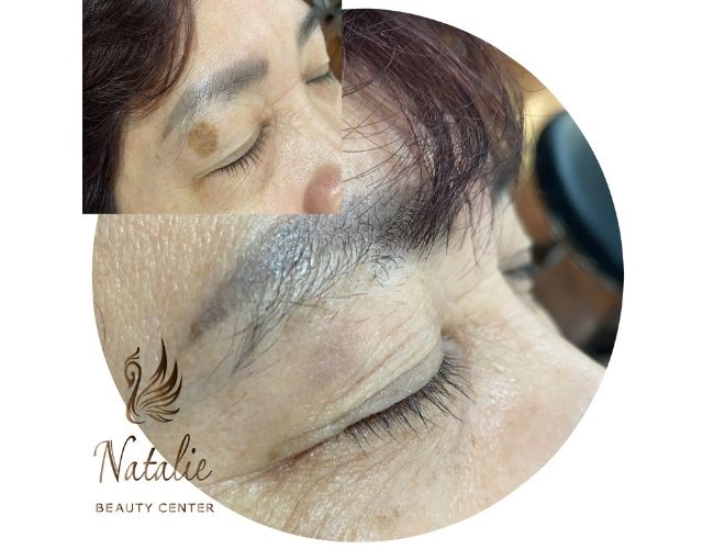 cac-bien-phap-dieu-tri-nam