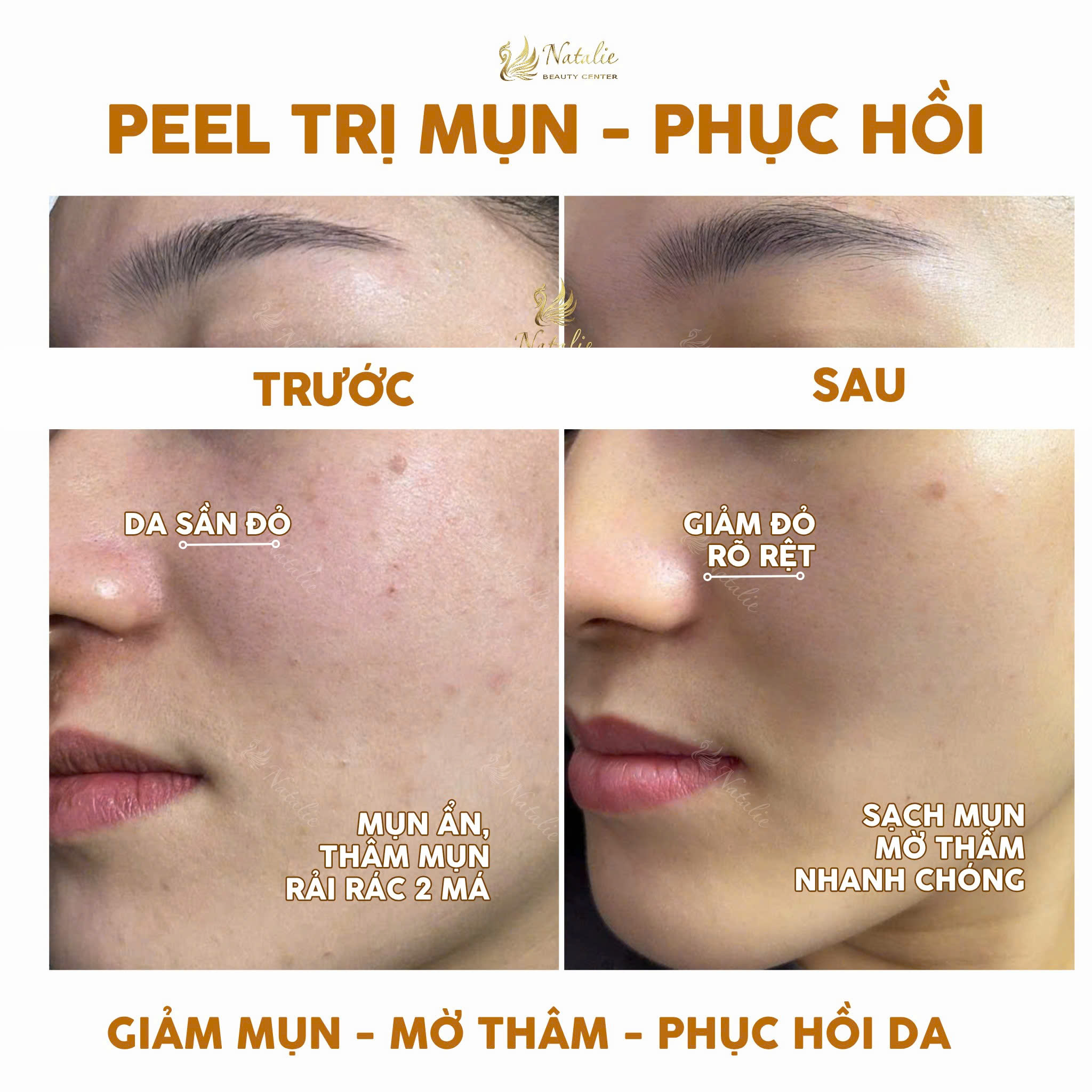 peel trị mụn một