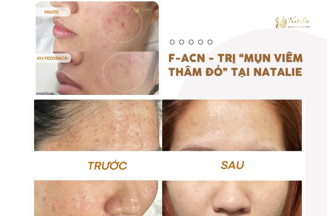 f-acn điều trị mụn viêm
