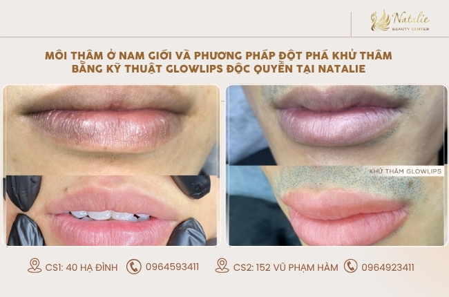 môi thâm độc quyền