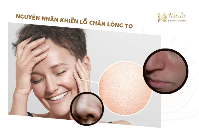 nguyên nhân lỗ chân lông to