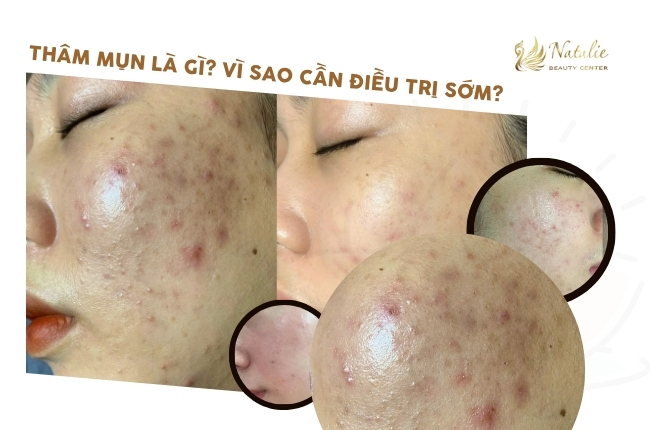 thâm mụn là gì? vì sao cần điều trị sớm