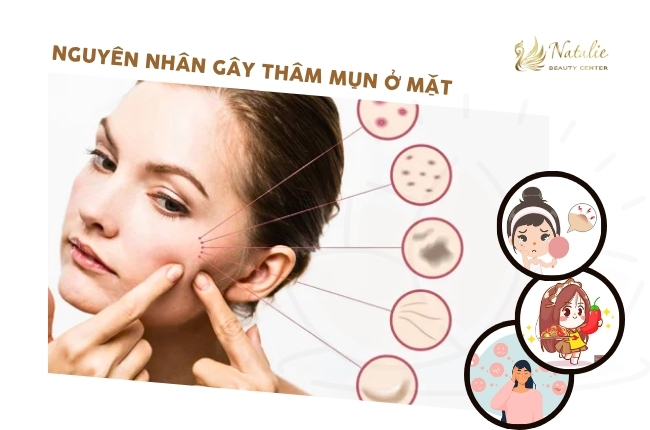 nguyên nhân thâm mụn mặt