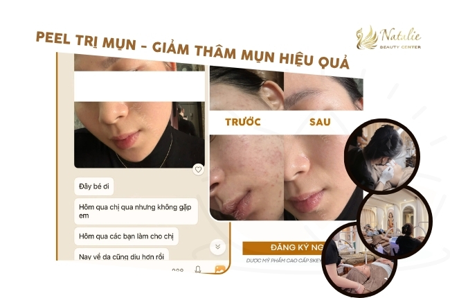 peel tri mun giam tham