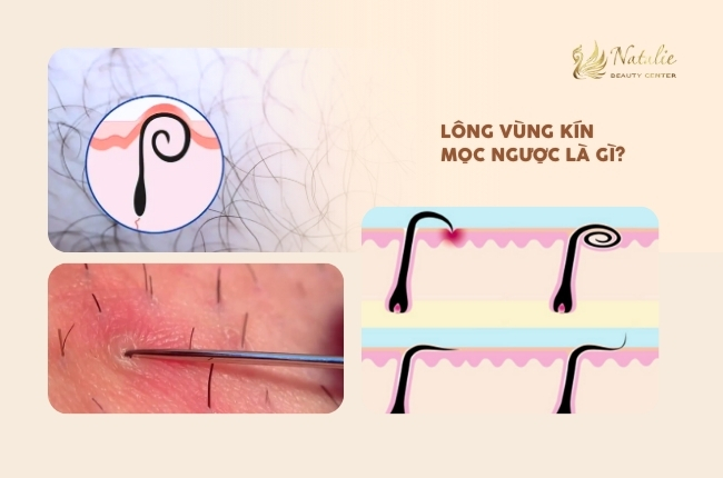 hình ảnh lông mọc ngược