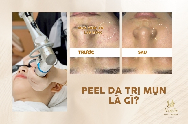 peel da trị mụn là gì?