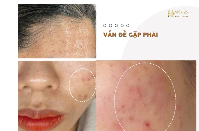 vấn đề da mụn viêm