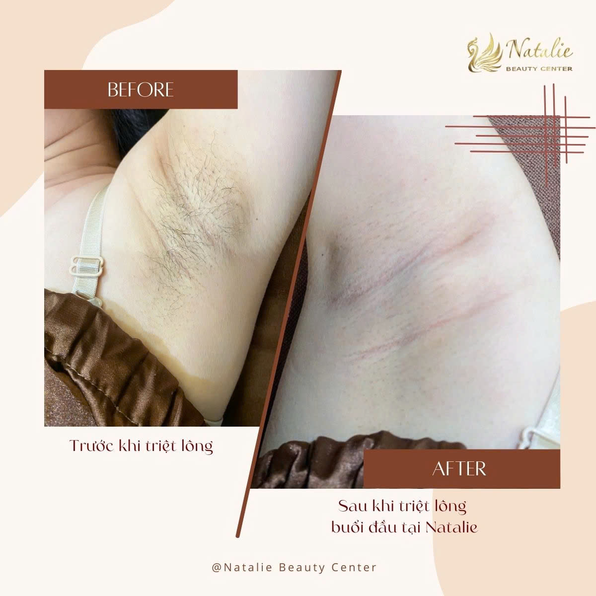 sau triệt nách na