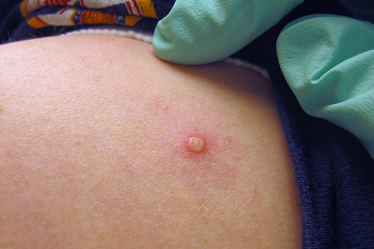 benh-dau-mua-khi-la-benh-gi