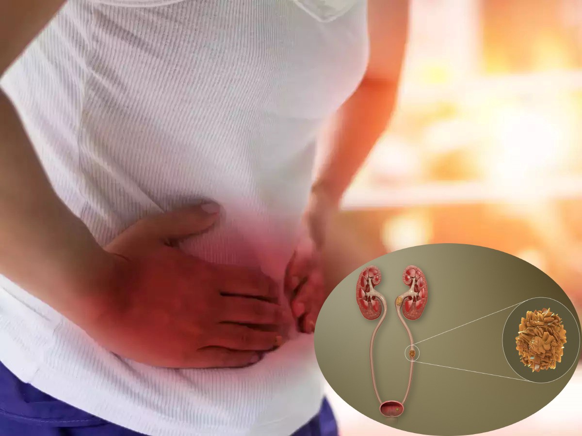 dieu-tri-soi-tiet-nieu