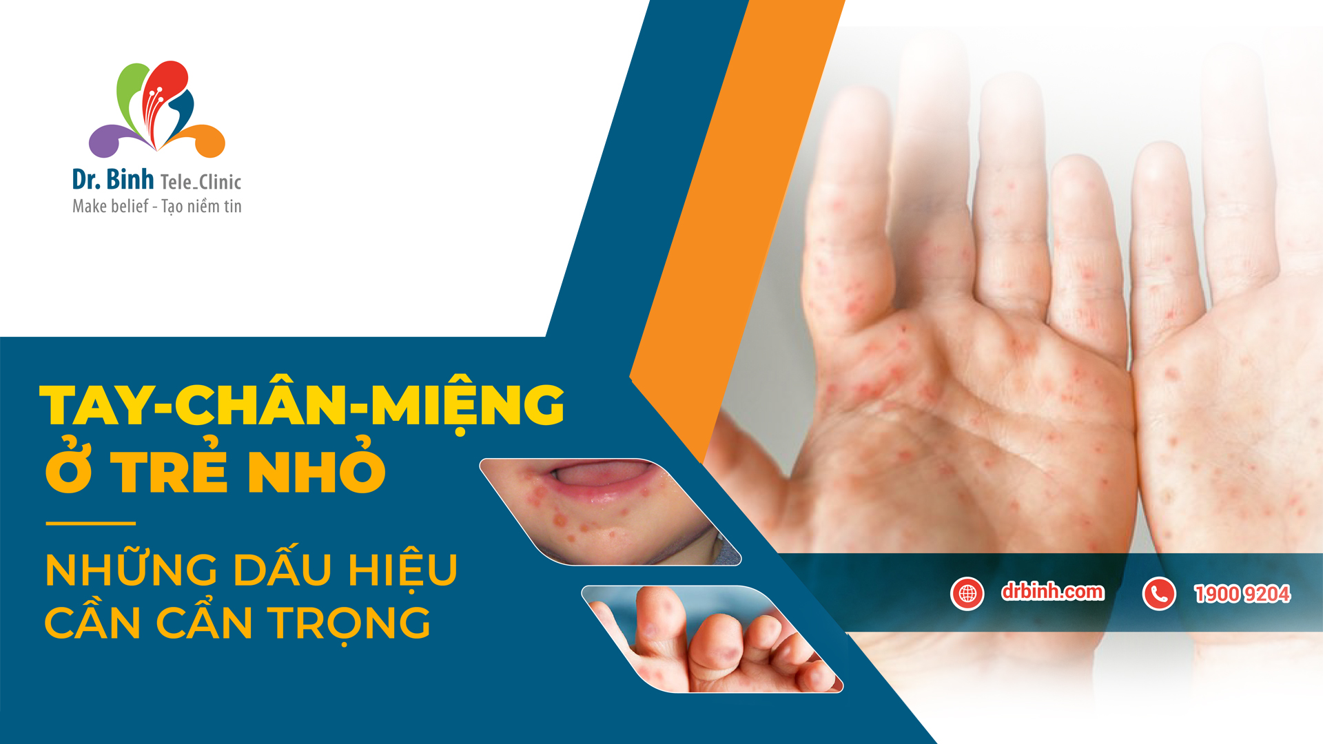 tay-chân-miệng-ở-trẻ