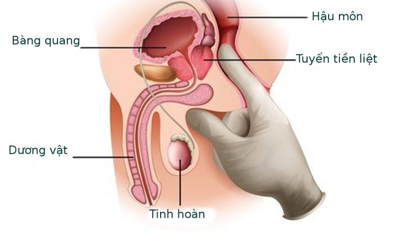 Triệu chứng bệnh khó phát hiện ở nam giới gây chậm trễ quá trình điều trị