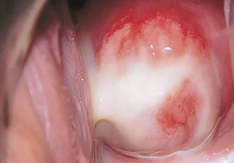 Hình ảnh dịch chảy ở cổ tử cung do bị mắc bệnh std Chlamydia