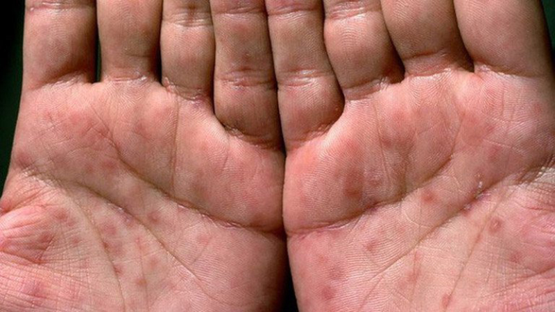 Biểu hiện giang mai giai đoạn 2 ở nam và nữ