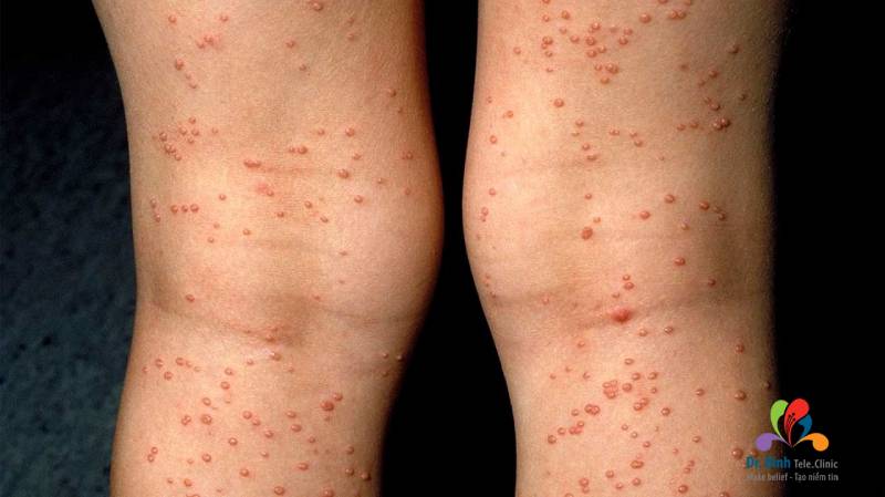 Các bệnh lây qua đường tình dục (STDs) được bác sĩ khuyến cáo