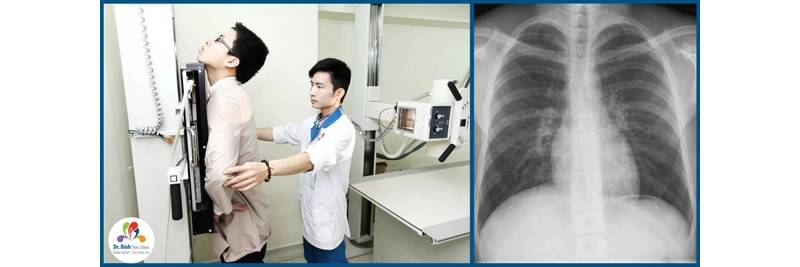 Chẩn đoán hình ảnh tại xương sườn bằng kỹ thuật chụp X-quang