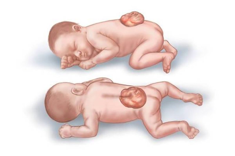 Thai phụ vẫn nê vẫn nên cảnh giác với những dị tật như Dị tật ống thần kinh, còn đuôi, sứt môi, hở hàm ếch, dính ngón…