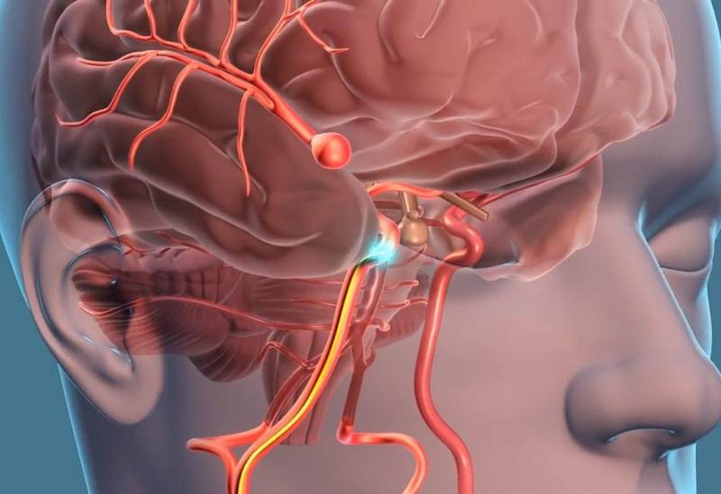 Bệnh tai biến mạch máu não (đột quỵ) là gì? Tình trạng nguy hiểm gây nguy hiểm tính mạng