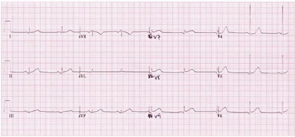 Hình ảnh điện tâm đồ nhồi máu cơ thành sau