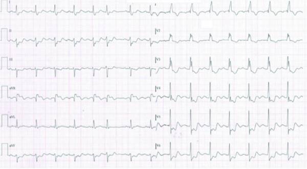 Hình ảnh điện tâm đồ nhồi máu cơ tim không ST chênh lên