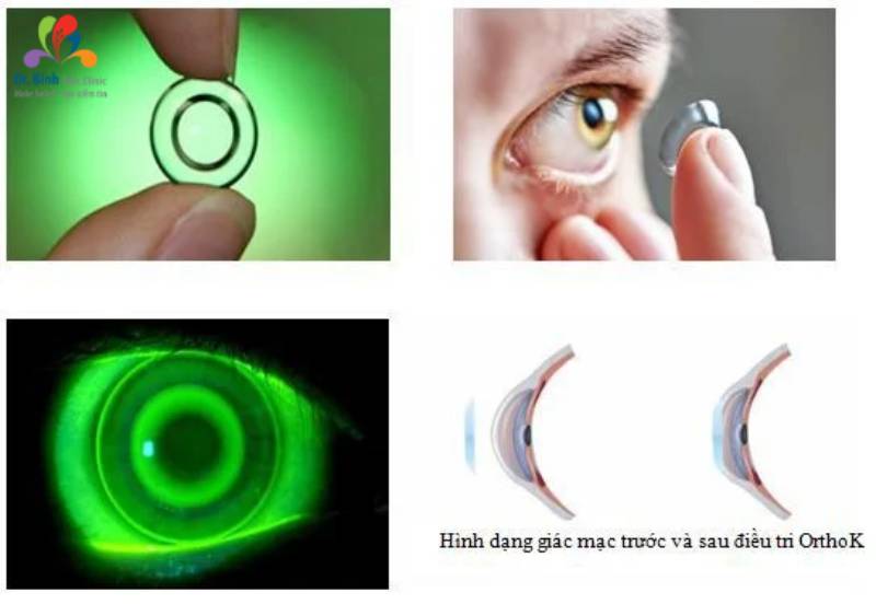 Lợi ích việc sử dụng thấu kính Ortho - K (Orthokeratology) điều trị mắt bị loạn thị