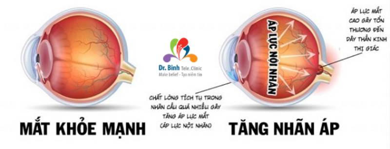 Tăng nhãn áp do sự tích tụ dịch thủy trong mắt