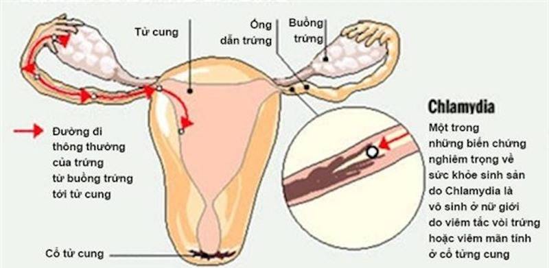 Biến chứng vô sinh do nhiễm vi khuẩn Chlamydia ở nữ