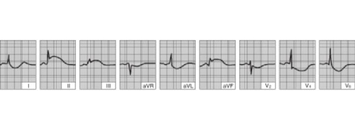 Hình ảnh nhồi máu cơ tim thành dưới cấp tính (trong vài giờ từ khi khởi phát bệnh)