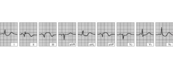Hình ảnh nhồi máu cơ tim thành dưới thất trái (sau 24 giờ đầu)