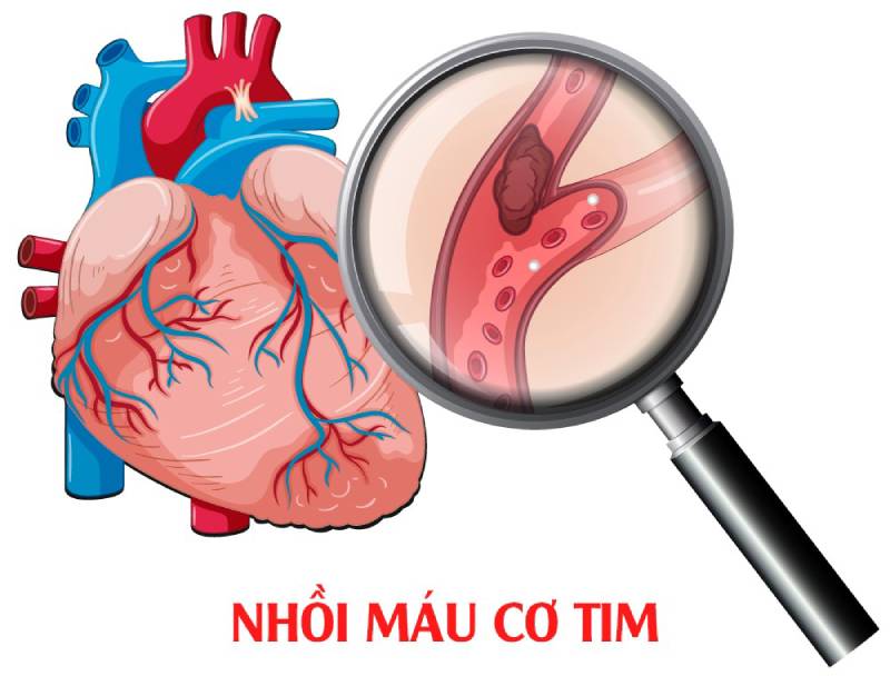Phân biệt nhồi máu cơ tim với các bệnh lý tim mạch khác