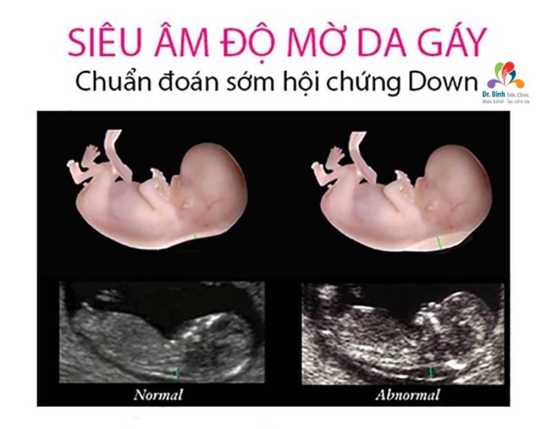 Siêu âm 4D có phát hiện bệnh Down không? Xét nghiệp triple test sau khi siêu âm 4D giúp kiểm tra kết quả phát hiện bệnh down