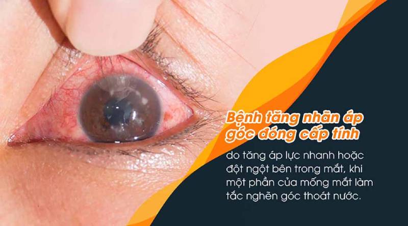 Bệnh tăng nhãn áp góc đóng cấp tính được bác sĩ khuyến cáo cần điều trị gấp