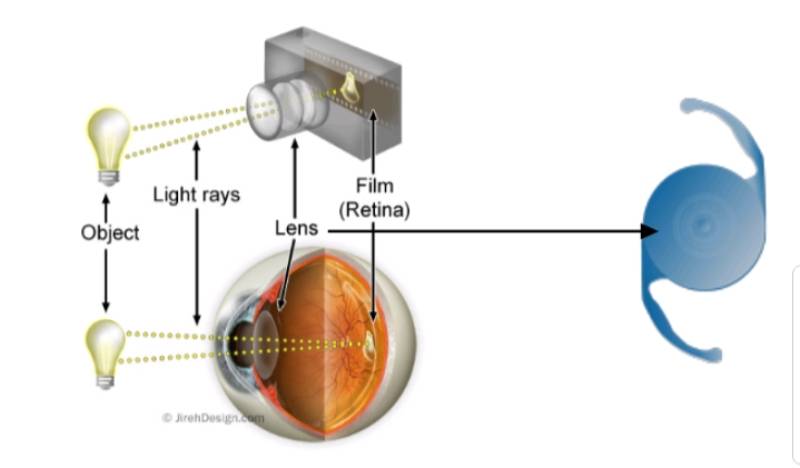 Cấu tạo thể thủy tinh nhan tạo được sử dụng trong phẫu thuật để chữa bệnh đục thủy tinh thể