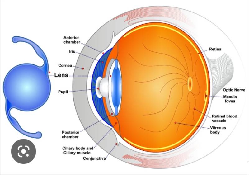 Thủy tinh thể nhân tạo Toric được sửa dụng để chữa bệnh loạn thị giác mạc đi kèm với bệnh đục thể thuỷ tinh