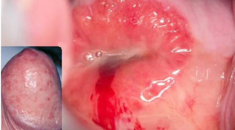 Hình ảnh bệnh chlamydia gây viêm đỏ ở dương vật ở nam giới