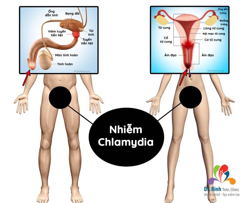 Chlamydia, bệnh lay qua đường tình dục phổ biến ở nam và nữ