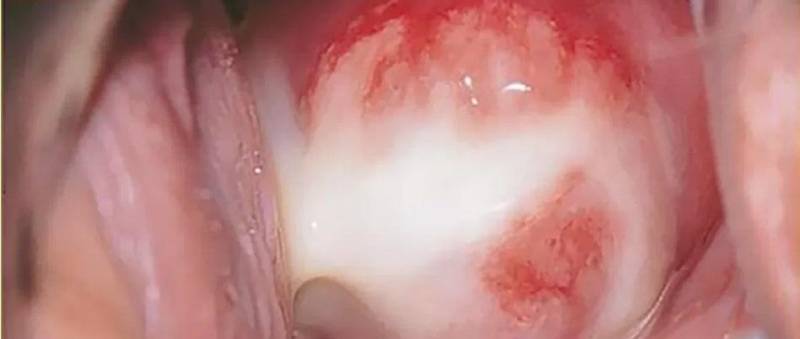 Bệnh Chlamydia nữ giới, căn bệnh nguy hiểm lây qua đường tình dục