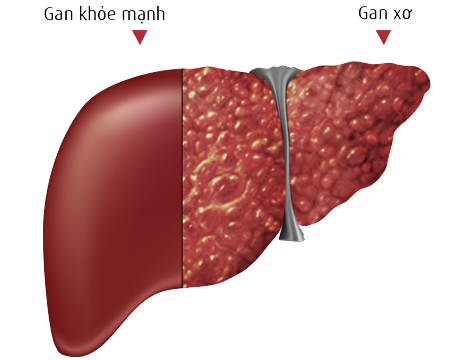 Bệnh xơ gan