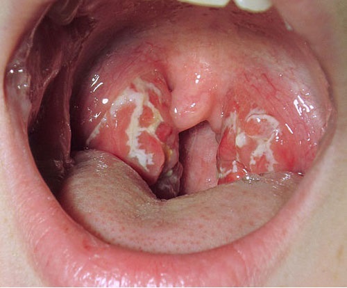 Ung thư vòm họng