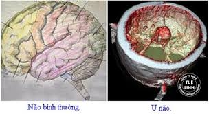 Bệnh  U não