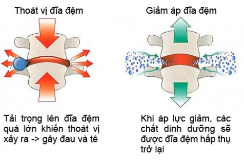 bệnh thoát vị đĩa đệm