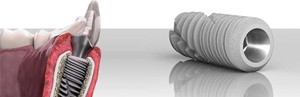 Hệ thống implant sử dụng