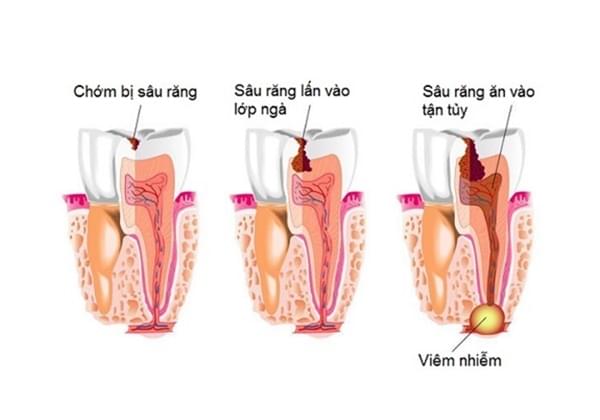 Điều trị tủy răng sữa