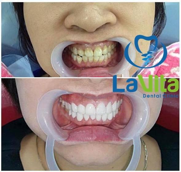 Những điều cần biết về chỉnh hình RHM