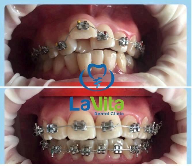 Những loại lệch lạc khớp cắn thường gặp