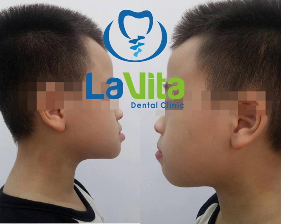 Những loại lệch lạc khớp cắn thường gặp