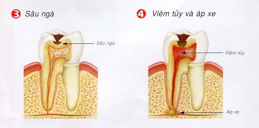 Bệnh sâu răng