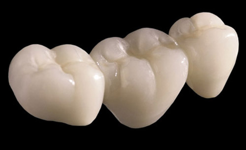 Răng sứ không kim loại Cercon
