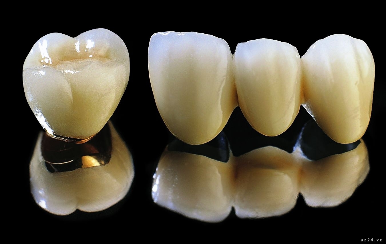 Răng sứ kim loại titan